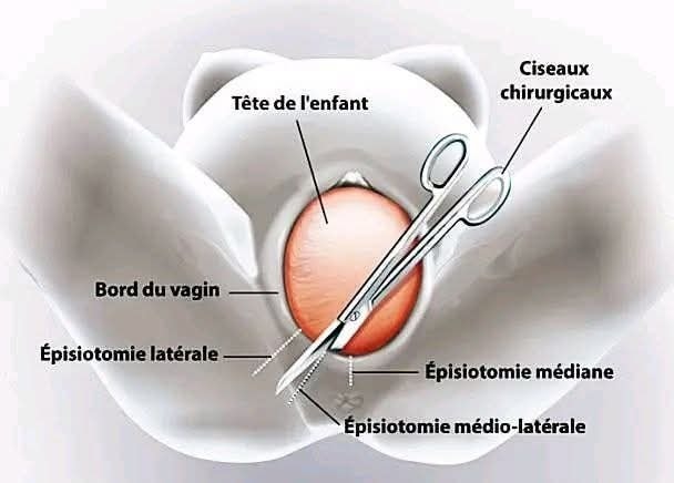 Santé : L’épisiotomie, cet acte chirurgicale effectué pendant l’accouchement